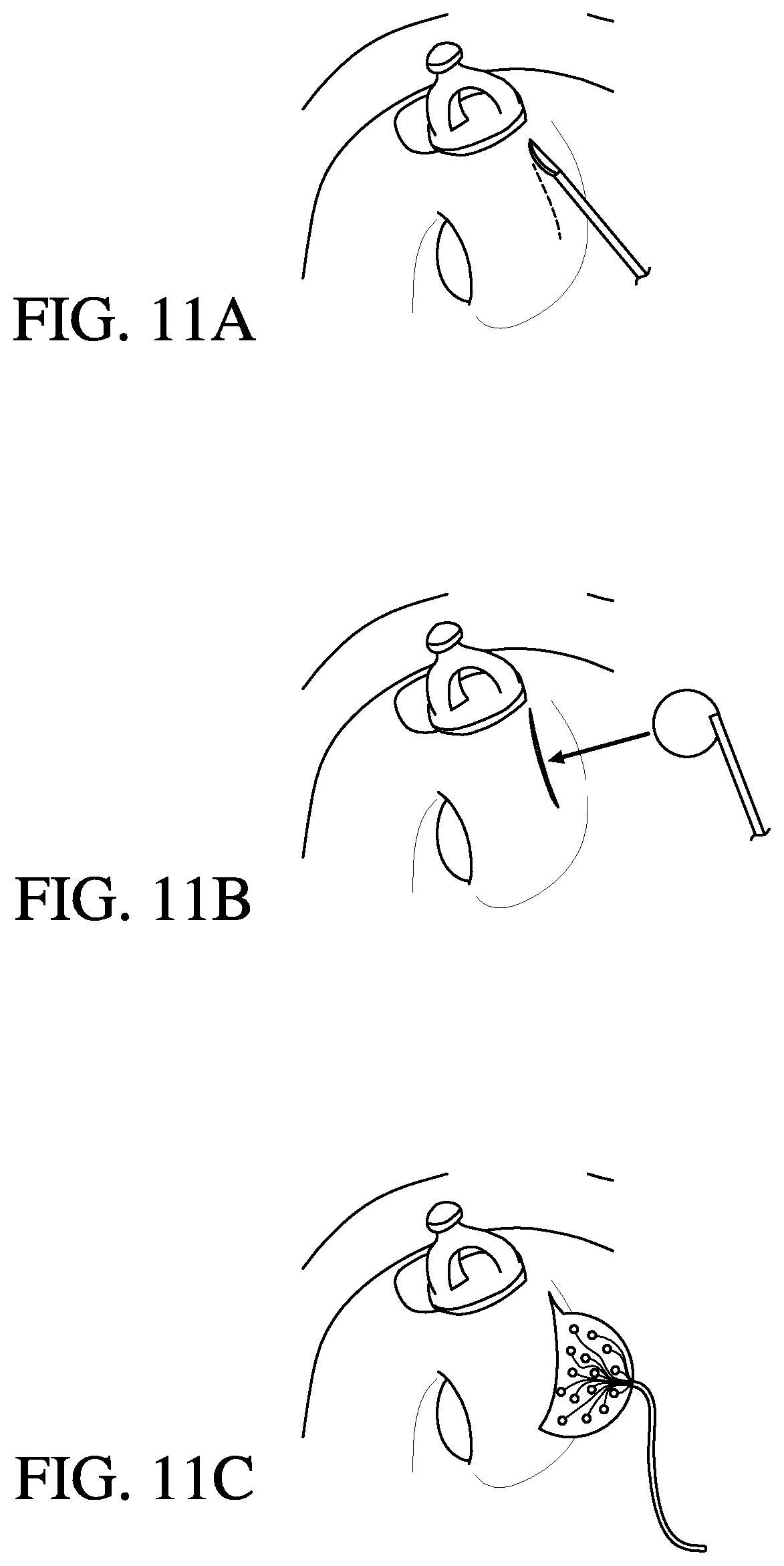 Patent US12616837 Figure 11 – Methods and apparatuses for extracochlear stimulation