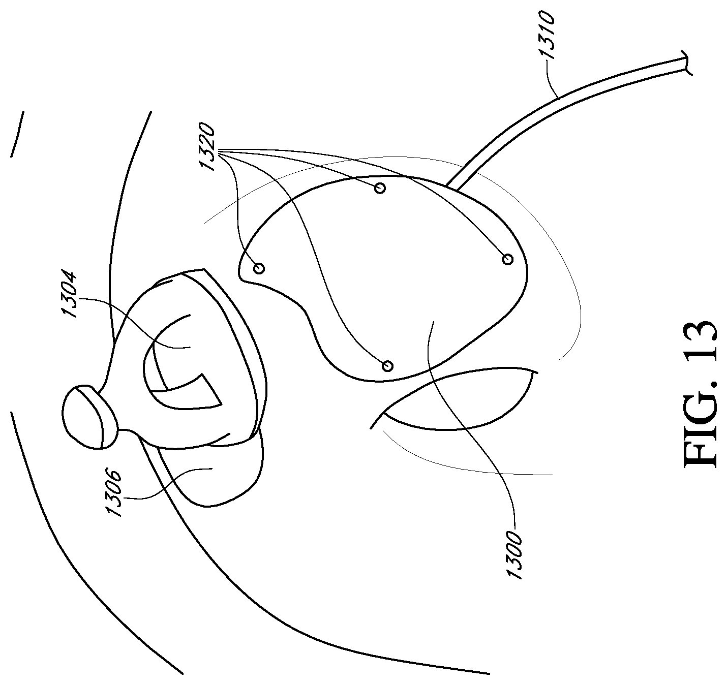 Patent US12616837 Figure 13 – Methods and apparatuses for extracochlear stimulation
