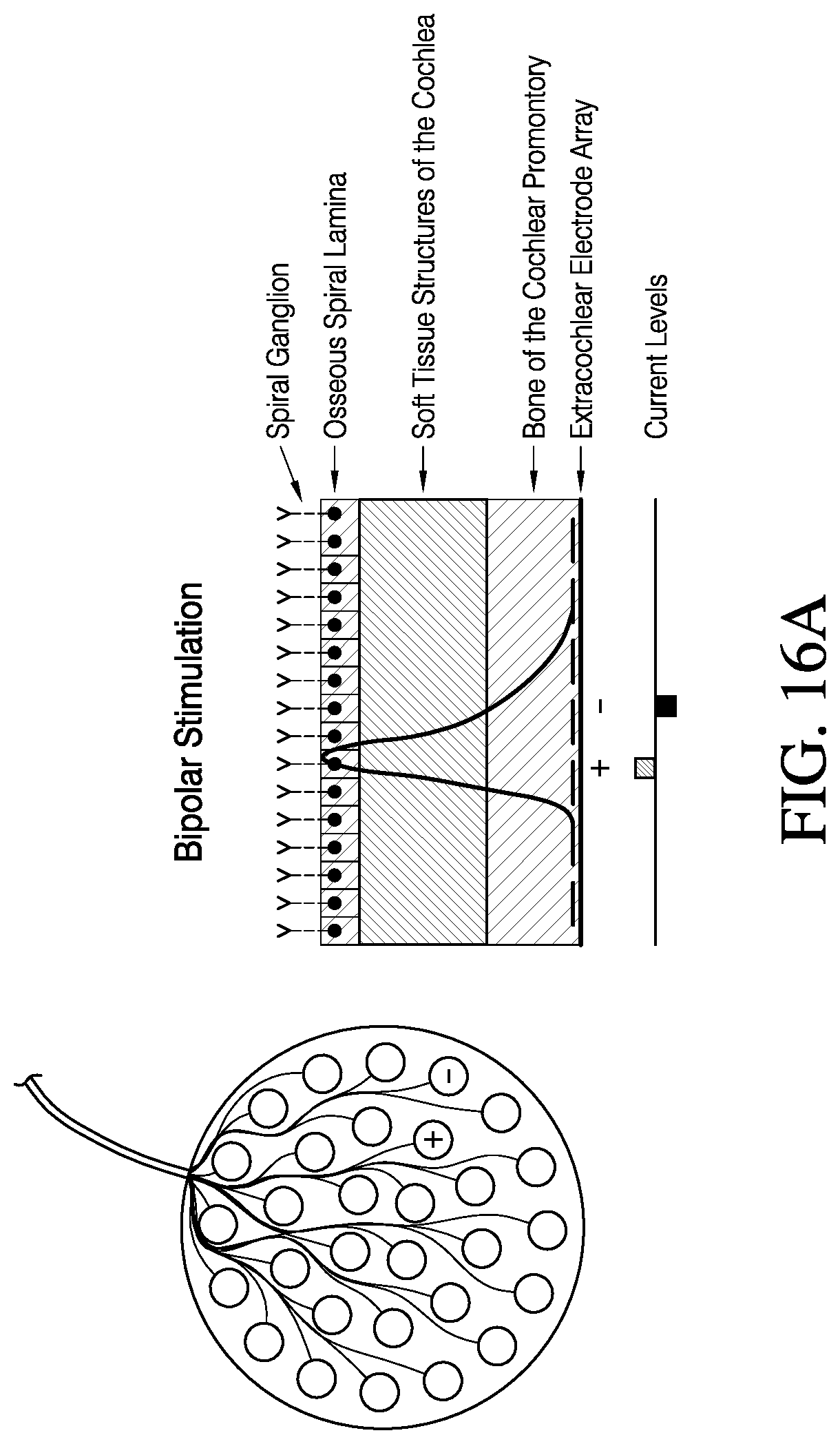 Patent US12616837 Figure 16 – Methods and apparatuses for extracochlear stimulation