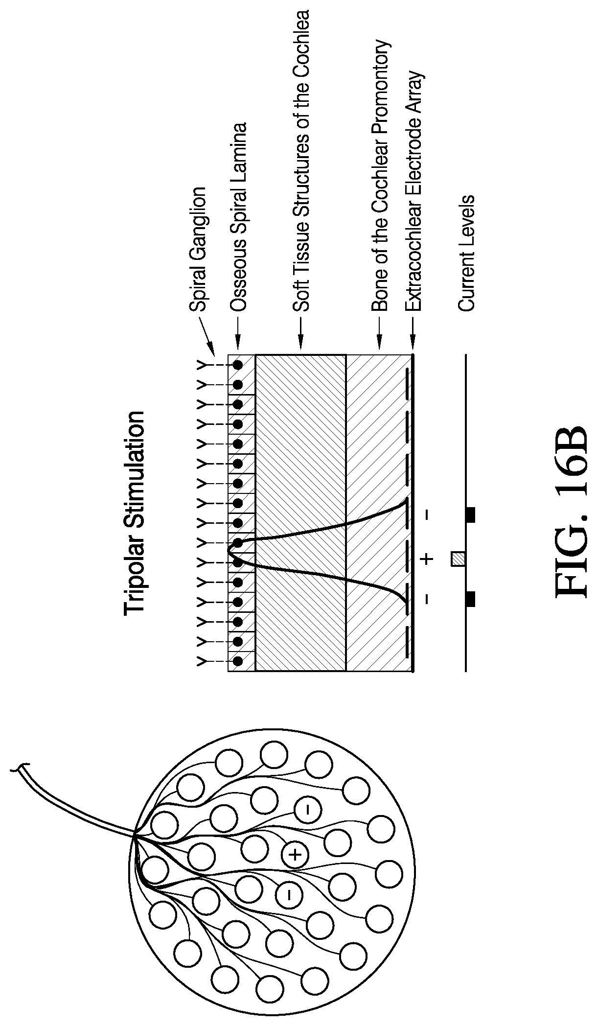 Patent US12616837 Figure 17 – Methods and apparatuses for extracochlear stimulation