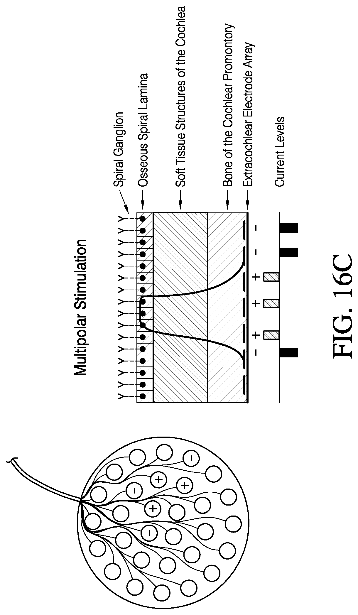 Patent US12616837 Figure 18 – Methods and apparatuses for extracochlear stimulation