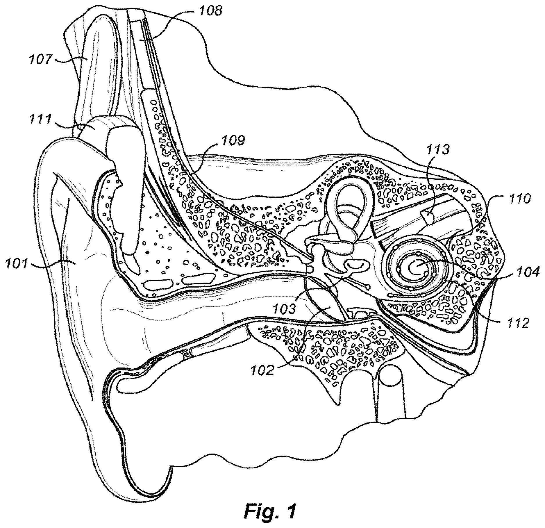 Patent US12616838 Figure 1 – Patient specific frequency mapping procedure for hearing implant electrode arrays
