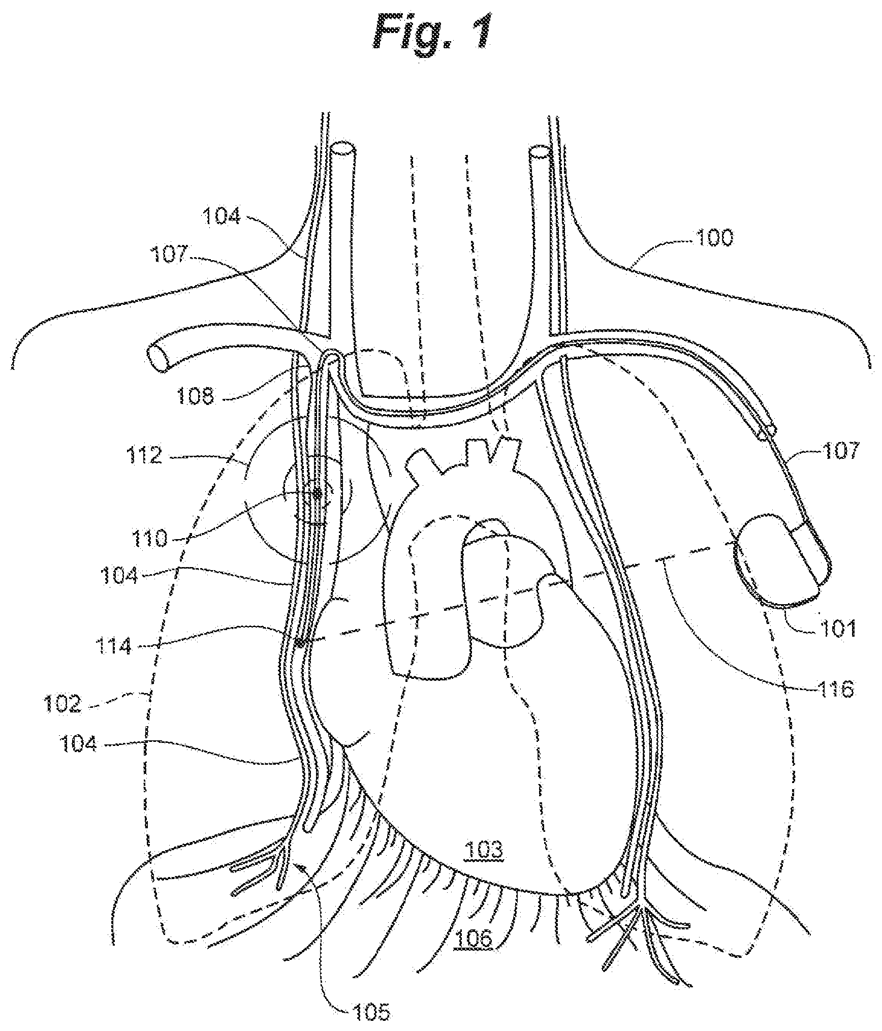 Patent US12616839 Figure 1 – System and method to modulate phrenic nerve to prevent sleep apnea