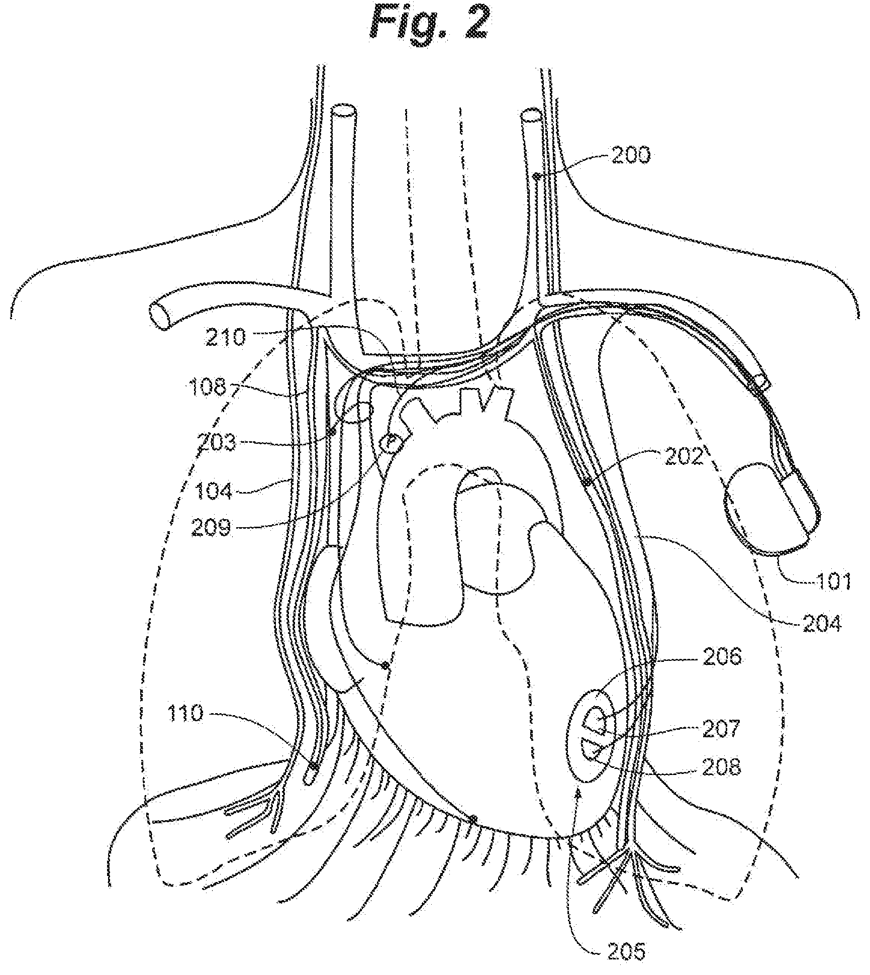 Patent US12616839 Figure 2 – System and method to modulate phrenic nerve to prevent sleep apnea