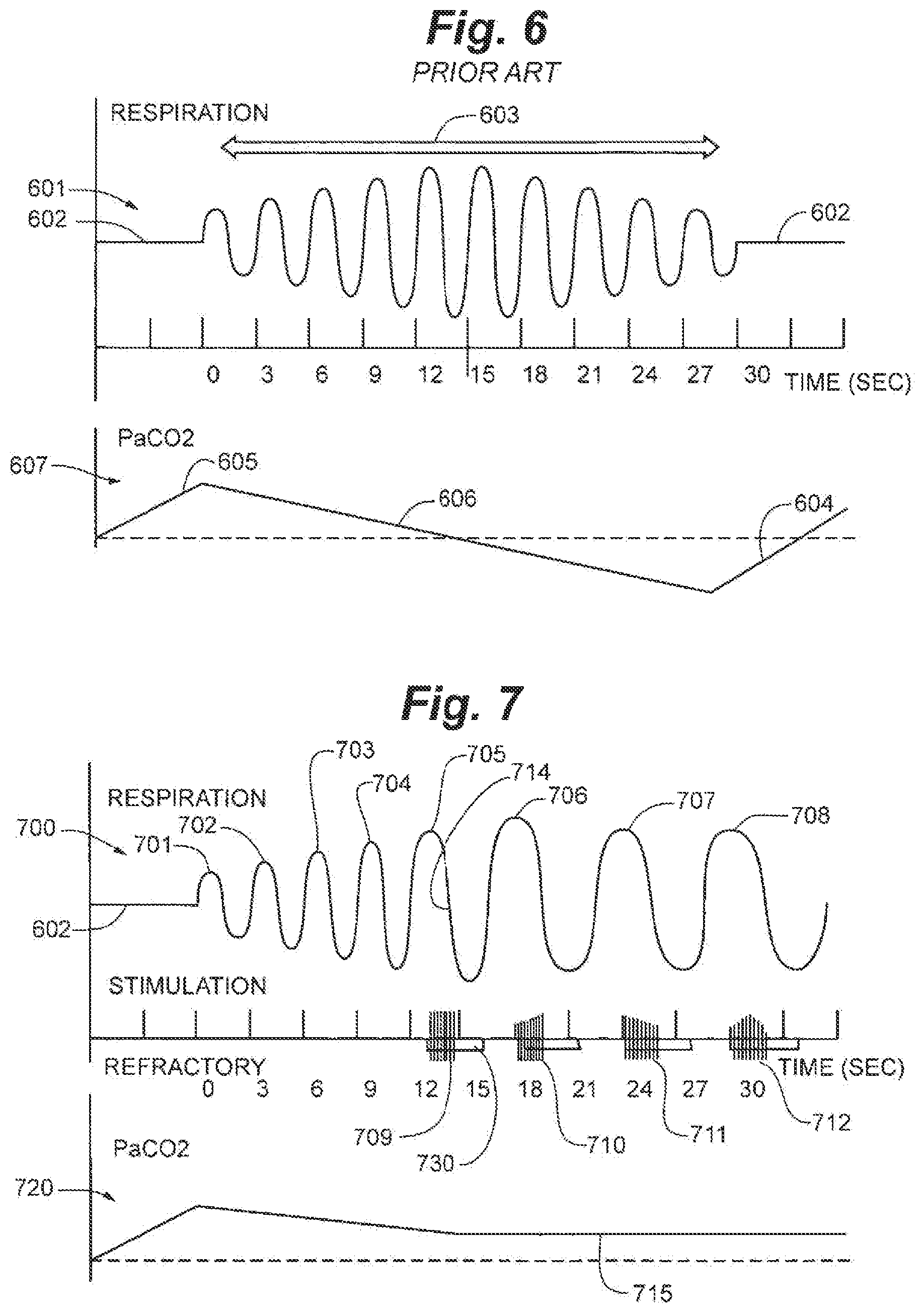 Patent US12616839 Figure 6 – System and method to modulate phrenic nerve to prevent sleep apnea