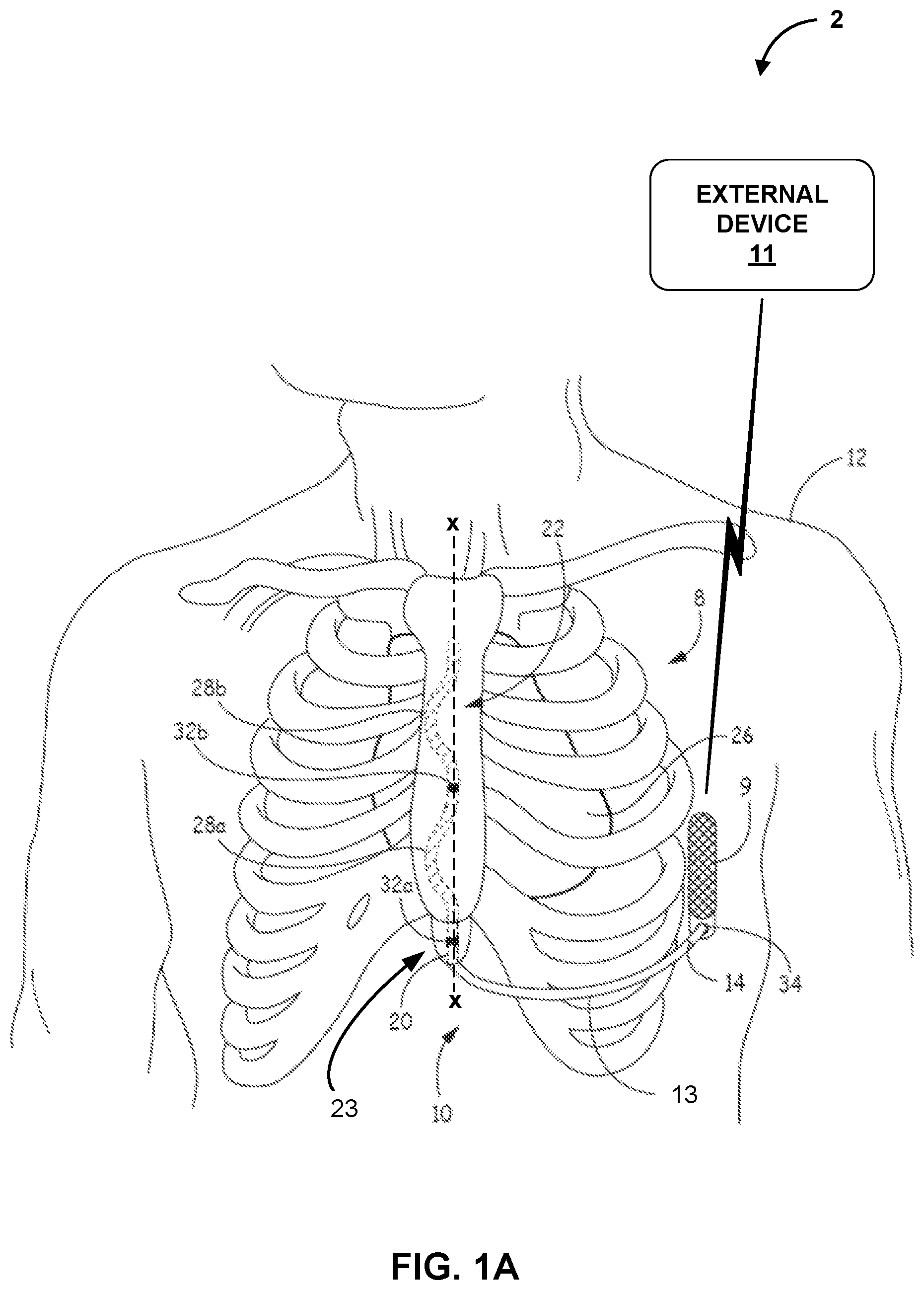 Patent US12616841 Figure 1 – Implantable medical device for detecting acoustic communication signals and acoustic biometric signals