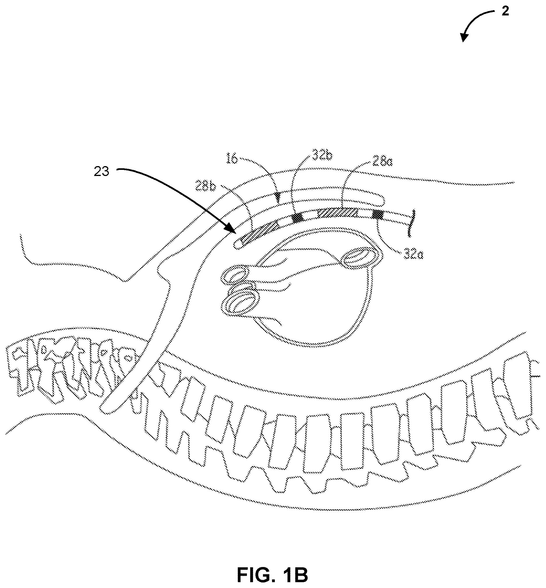 Patent US12616841 Figure 2 – Implantable medical device for detecting acoustic communication signals and acoustic biometric signals