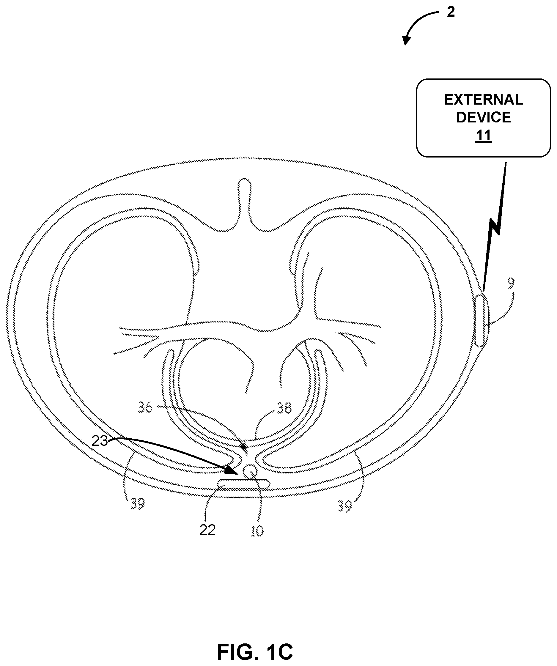 Patent US12616841 Figure 3 – Implantable medical device for detecting acoustic communication signals and acoustic biometric signals