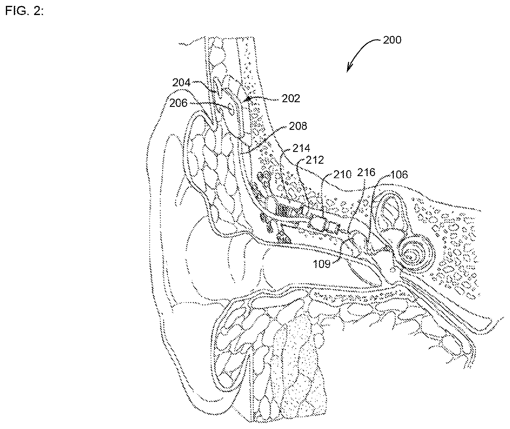 Patent US12616842 Figure 2 – Self-locking fixation system for medical implant