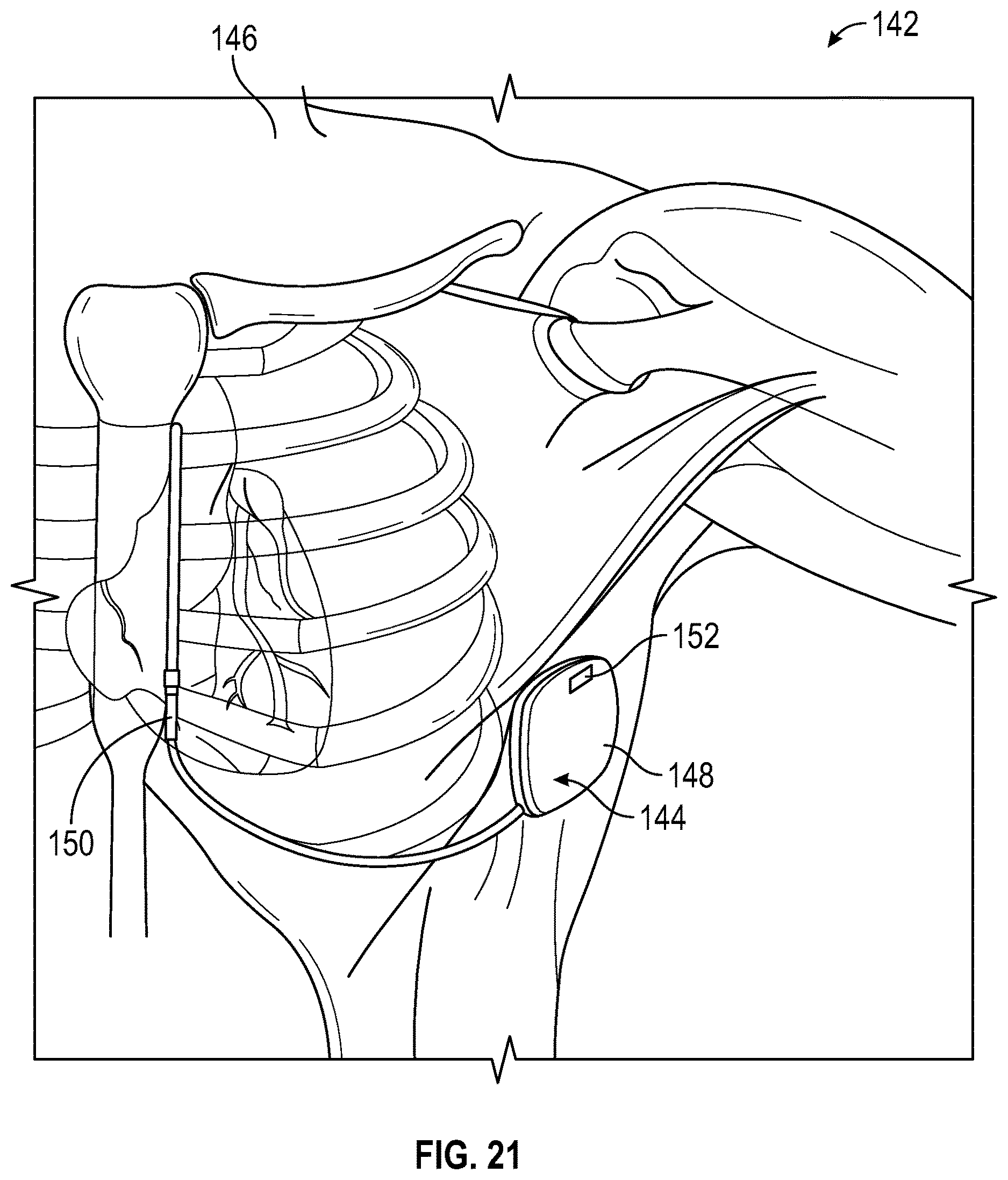 Patent US12616845 Figure 19 – Devices and related methods for light-based modulation of foreign body responses in living tissue