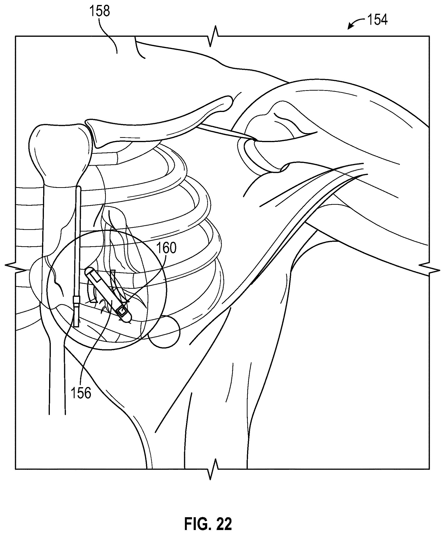 Patent US12616845 Figure 20 – Devices and related methods for light-based modulation of foreign body responses in living tissue