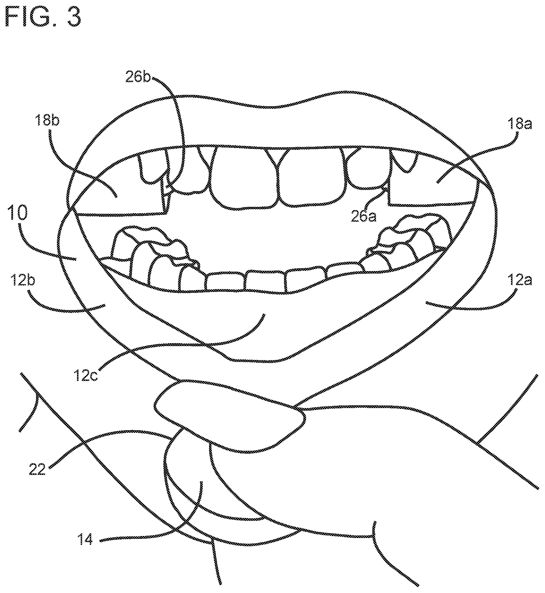 Patent US12616873 Figure 3 – Mandibular advancement device