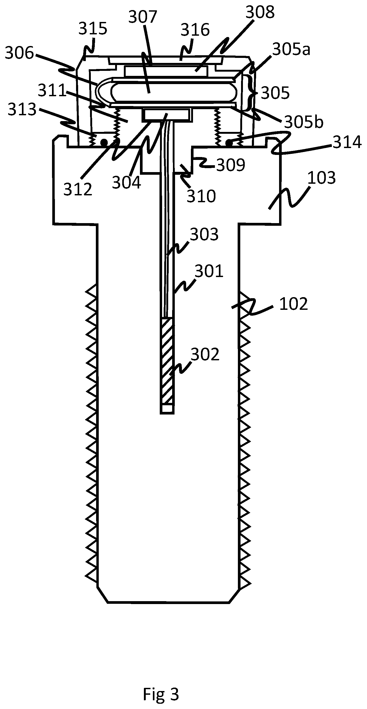 Patent US12618733 Figure 2 – Tension monitoring apparatus including a fixing with a shank under tension and a strain sensor embedded in the shank where the strain sensor is connected to a data processing means