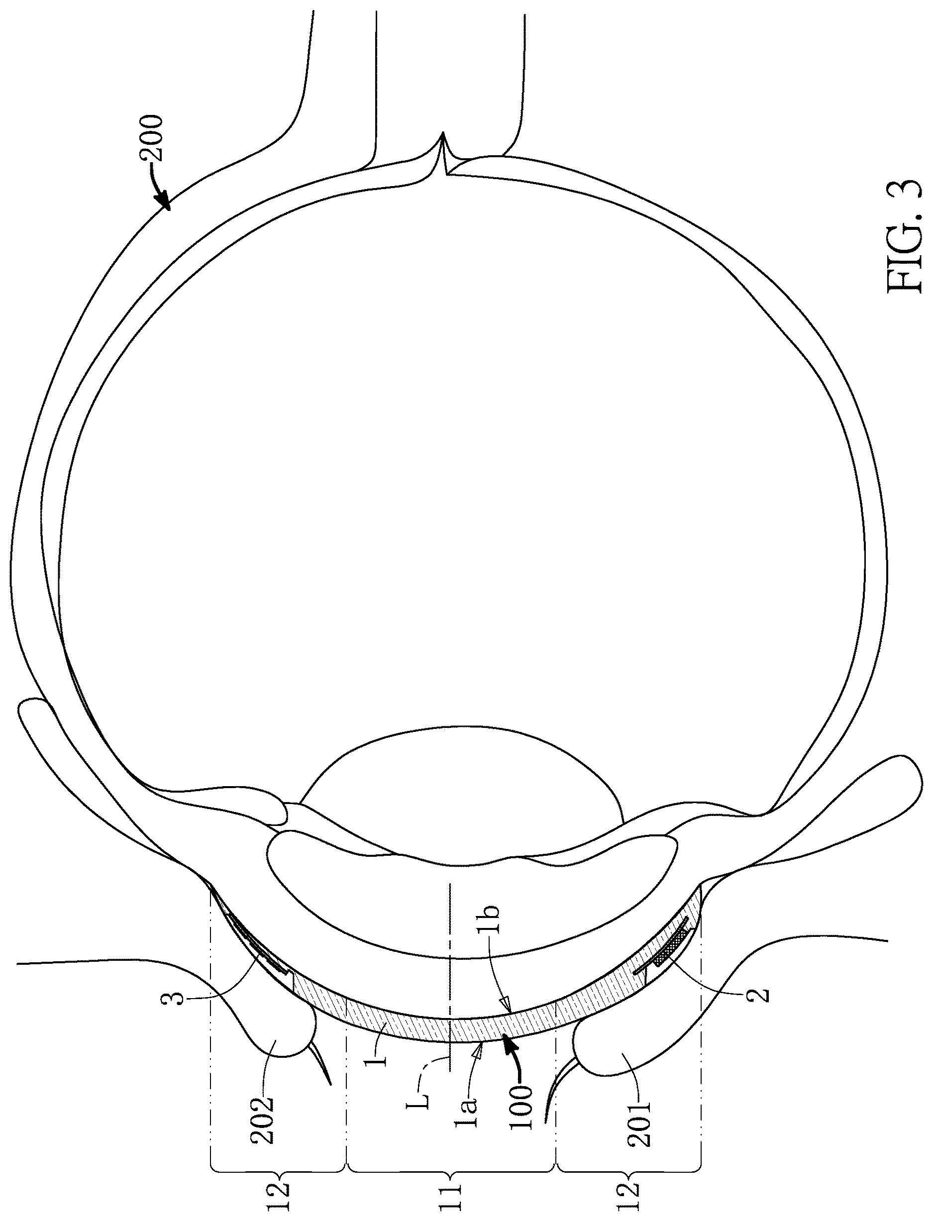 Patent US12619105 Figure 3 – Contact lens