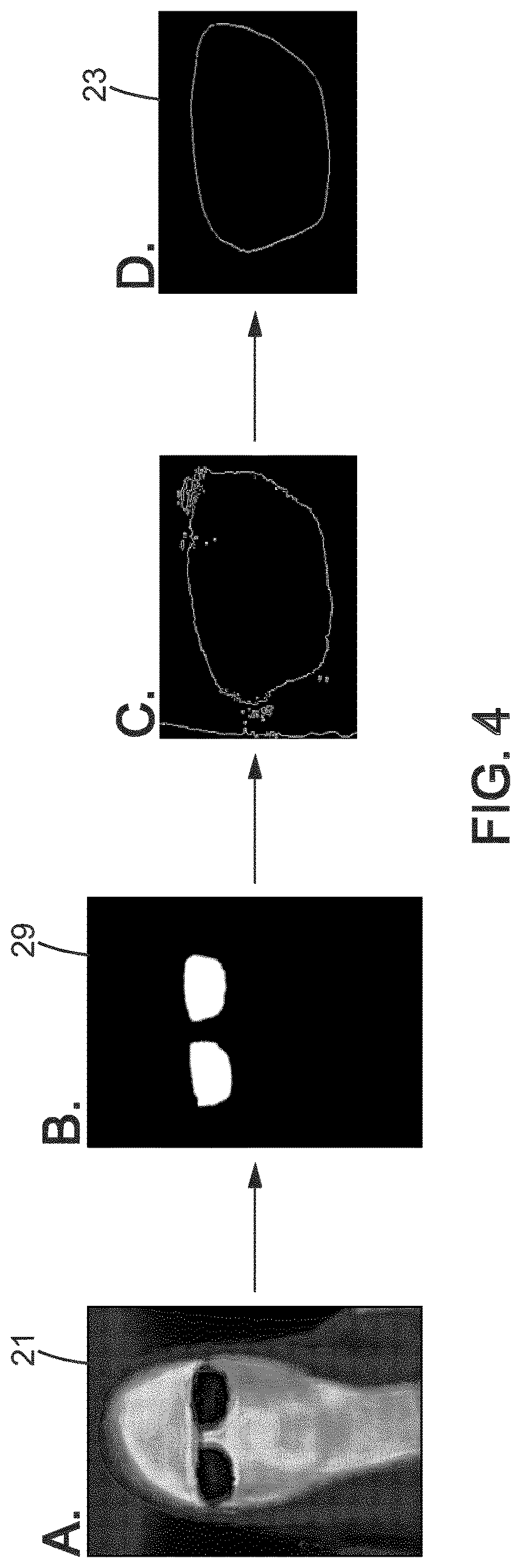 Patent US12619107 Figure 4 – Photography and thermography combining method of obtaining a fitting parameter to fit an ophthalmic lens into a spectacle frame
