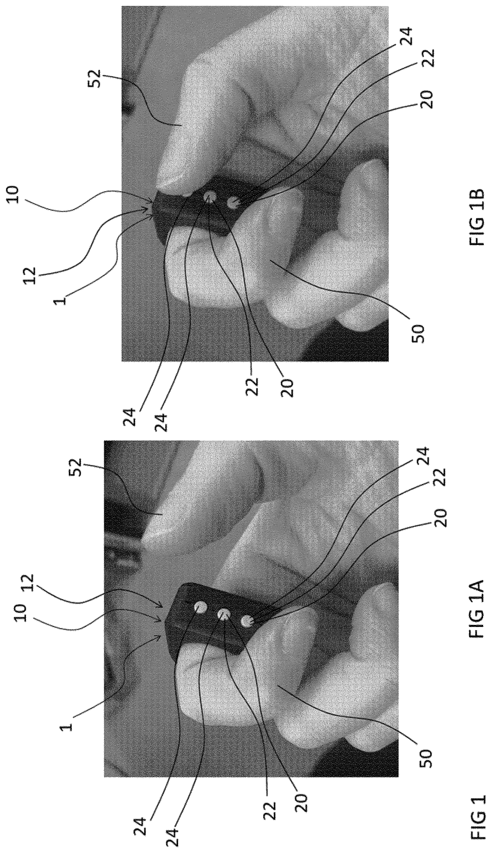 Patent US12619306 Figure 1 – Wearable control system and method to control an ear-worn device