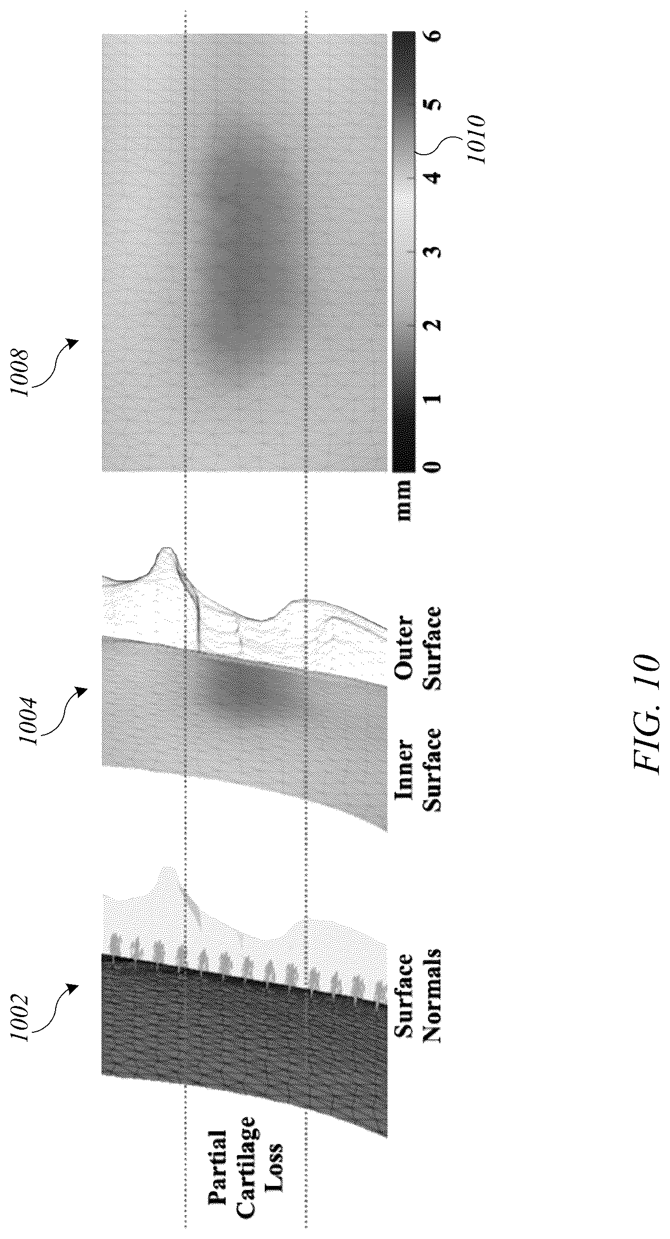 Patent US12620088 Figure 15 – System and method for articular cartilage thickness mapping and lesion quantification