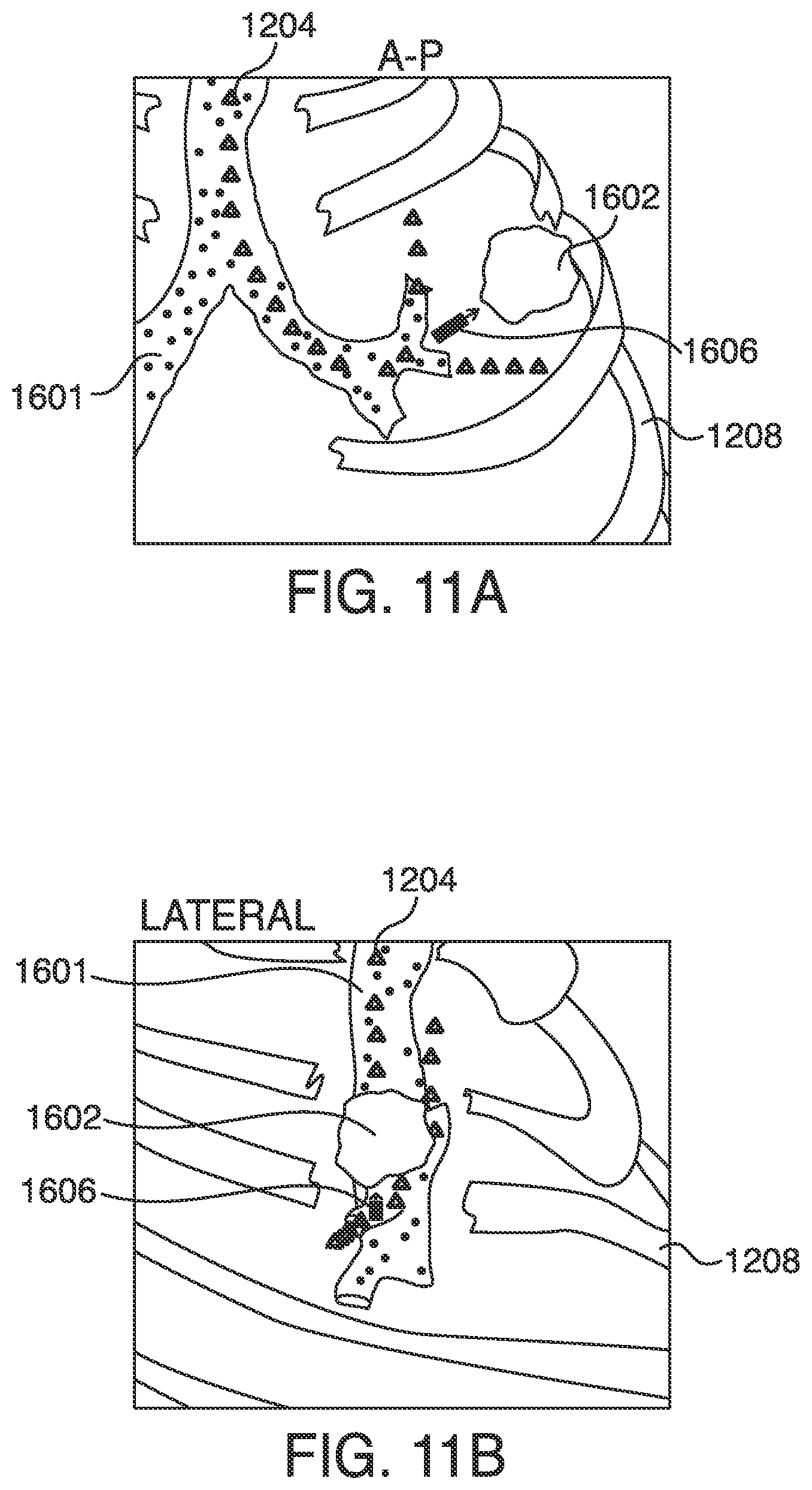 Patent US12620101 Figure 11 – Systems, methods and devices for forming respiratory-gated point cloud for four dimensional soft tissue navigation