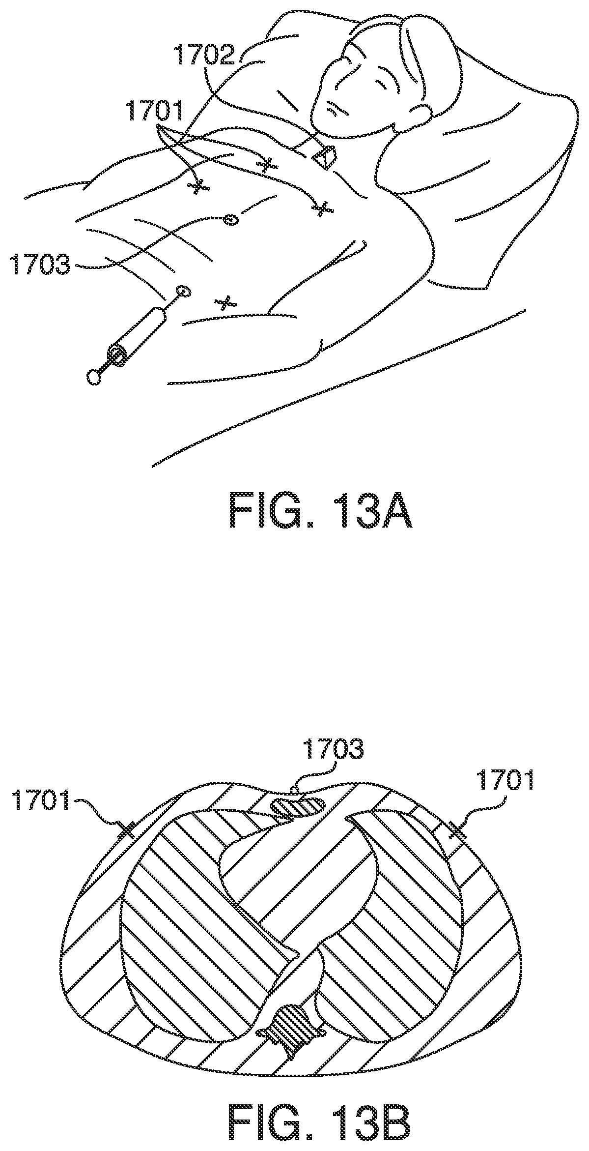 Patent US12620101 Figure 13 – Systems, methods and devices for forming respiratory-gated point cloud for four dimensional soft tissue navigation