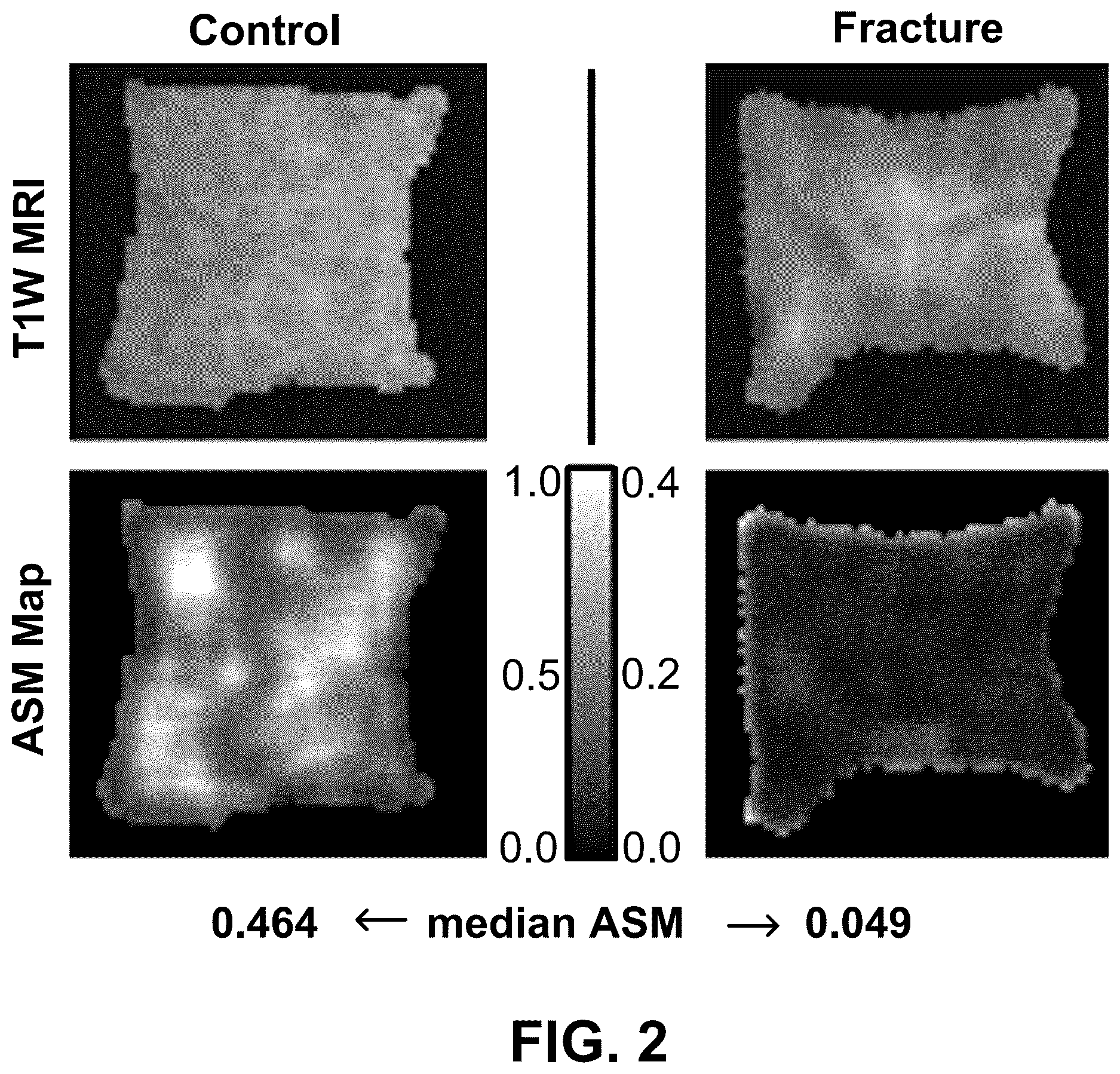 Patent US12620106 Figure 2 – MRI-based textural analysis of trabecular bone