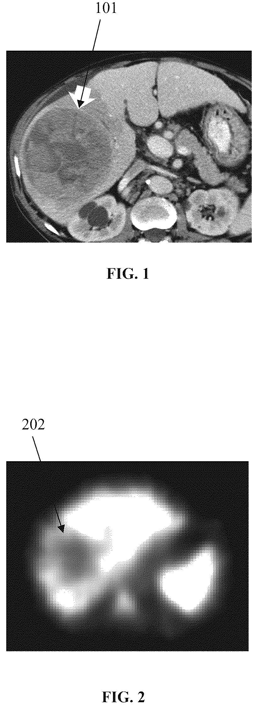 Patent US12620468 Figure 1 – Personalized liver cancer treatment