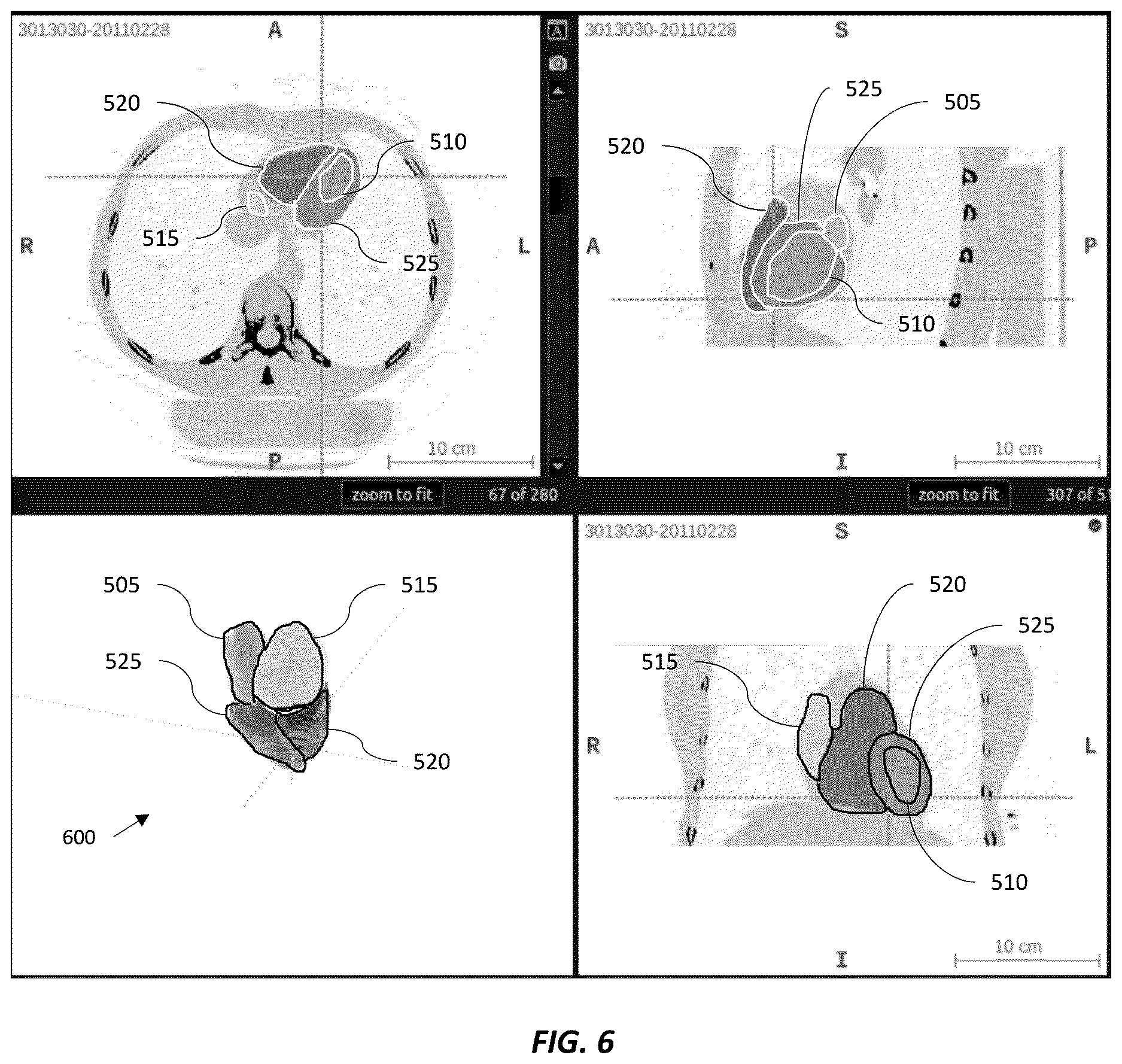 Patent US12620494 Figure 4 – Predicting adverse health risk based on CT scan images and AI-enabled cardiovascular structure volumetry