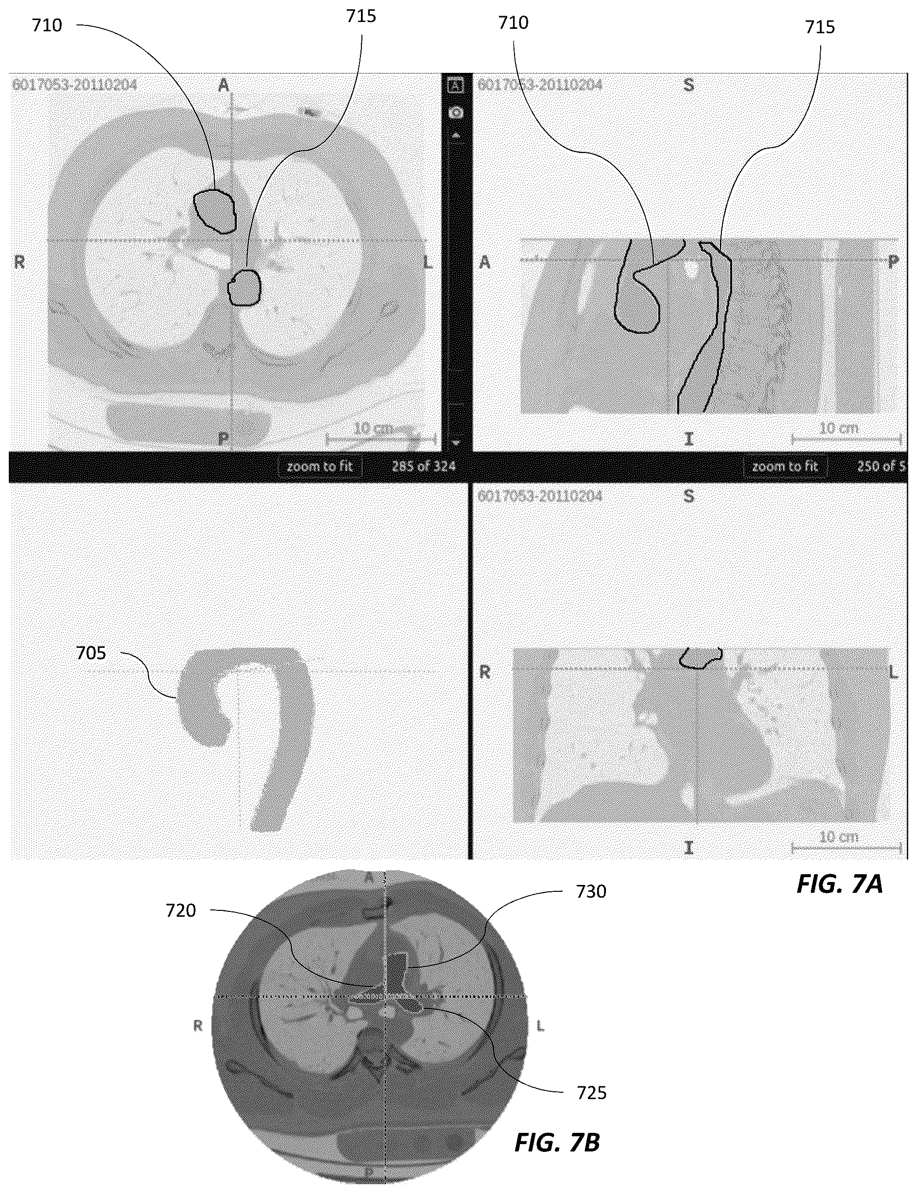 Patent US12620494 Figure 5 – Predicting adverse health risk based on CT scan images and AI-enabled cardiovascular structure volumetry