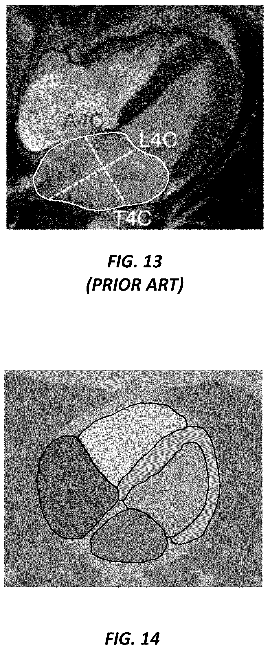 Patent US12620494 Figure 9 – Predicting adverse health risk based on CT scan images and AI-enabled cardiovascular structure volumetry