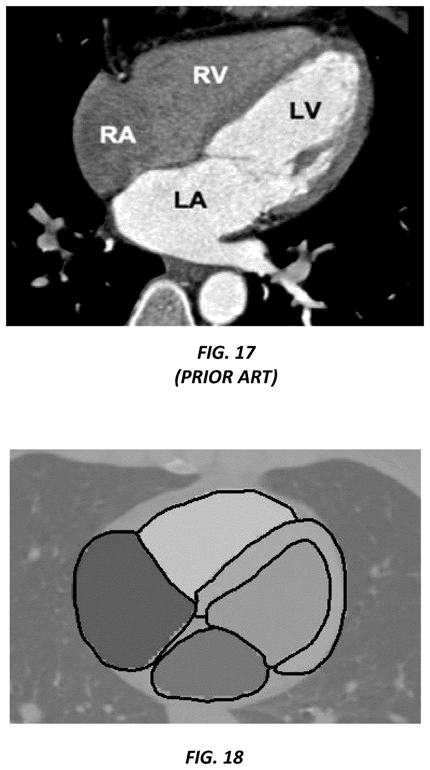 Patent US12620494 Figure 11 – Predicting adverse health risk based on CT scan images and AI-enabled cardiovascular structure volumetry