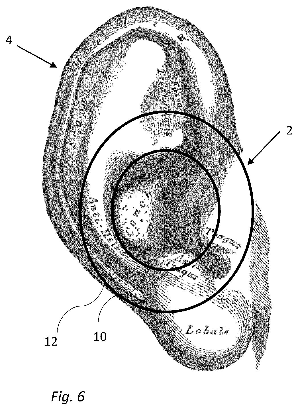 Patent US12621599 Figure 6 – On-the-ear ear cushion with multiple foams having different properties