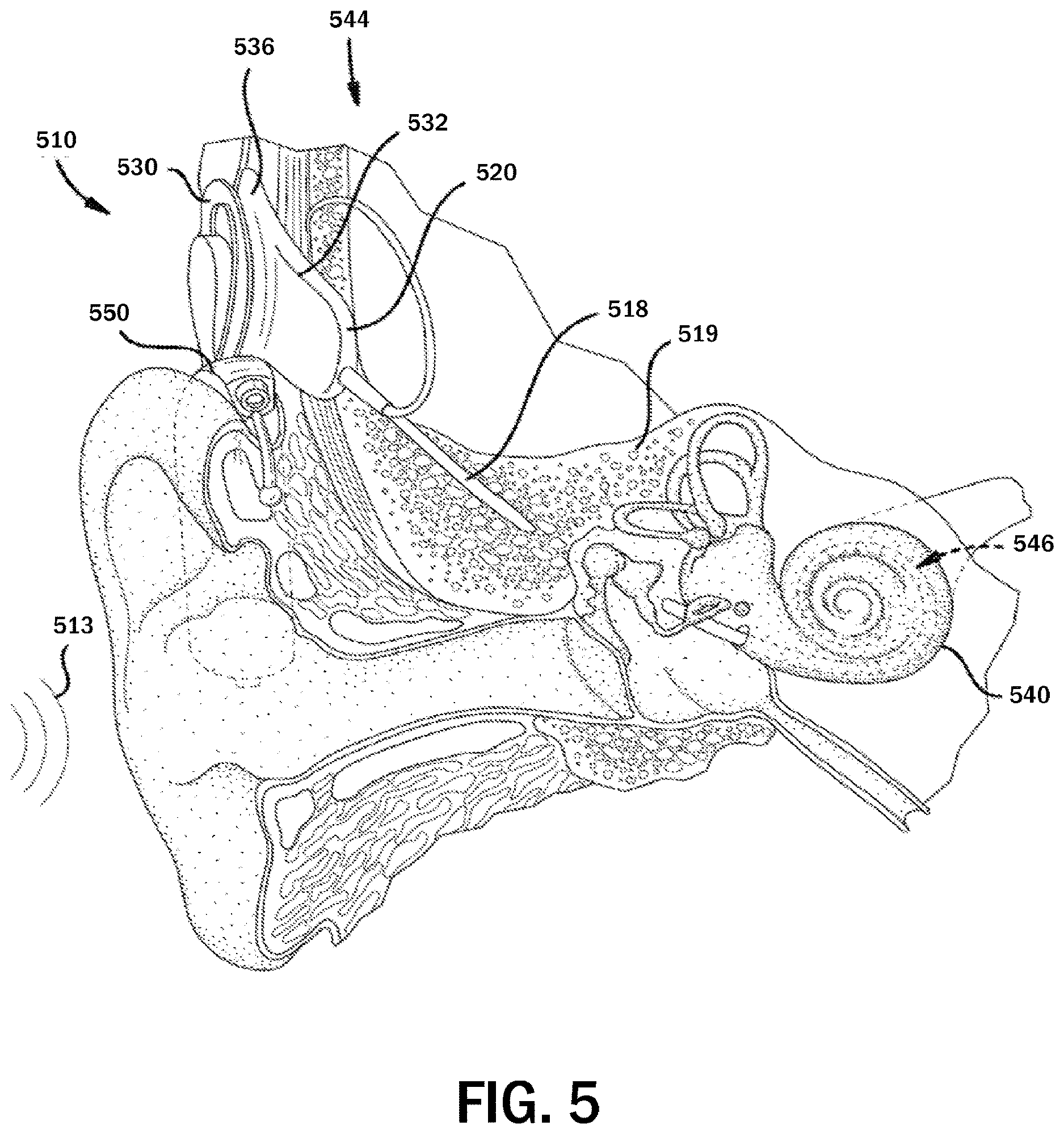 Patent US12621617 Figure 5 – Musical perception of a recipient of an auditory device