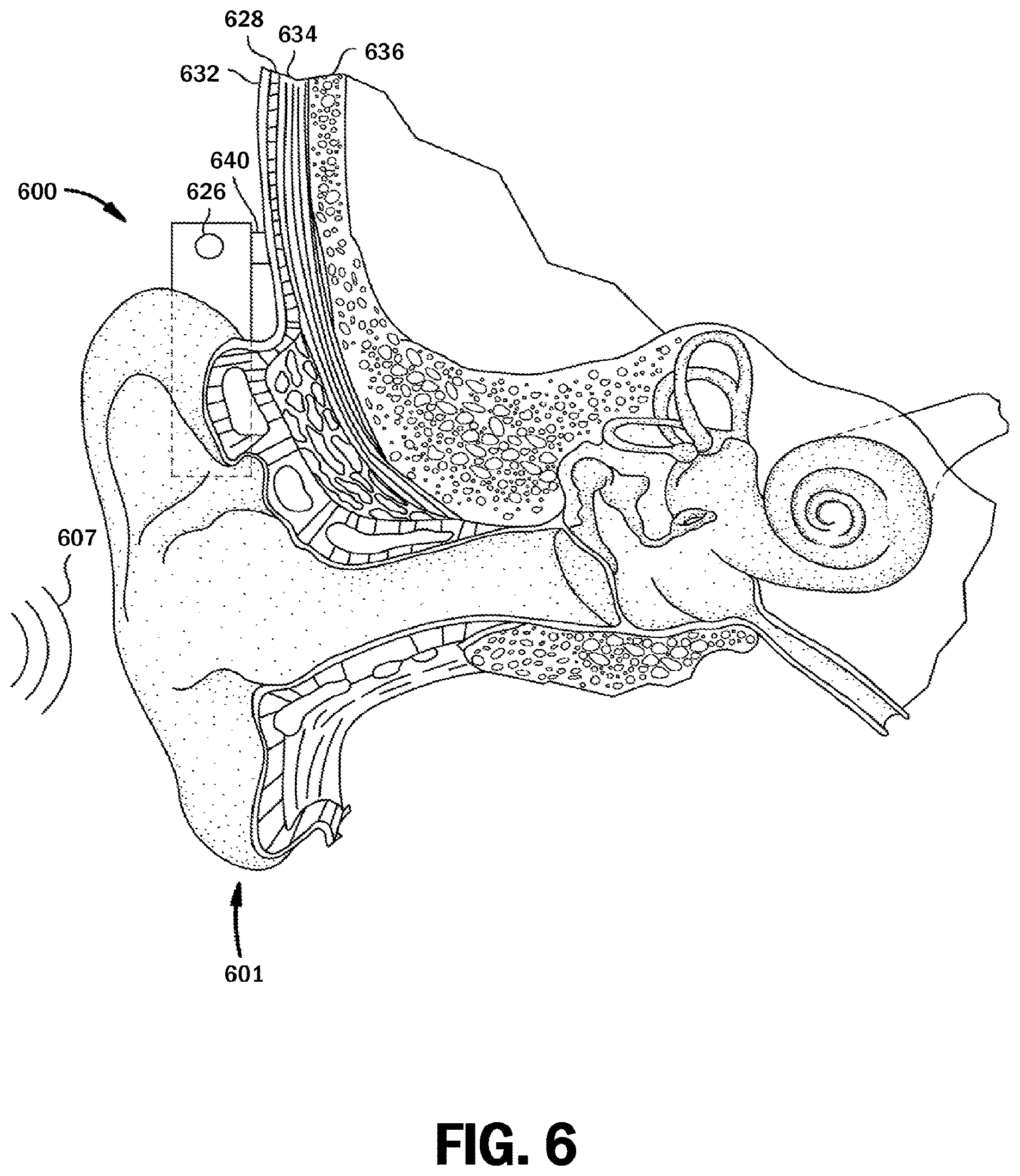 Patent US12621617 Figure 6 – Musical perception of a recipient of an auditory device
